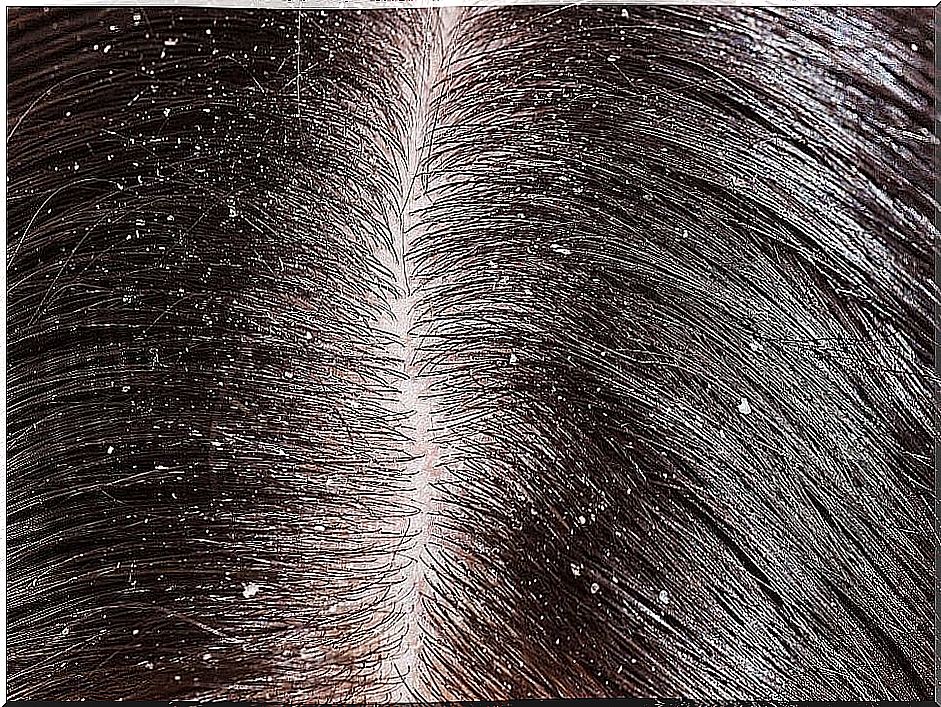 dandruff