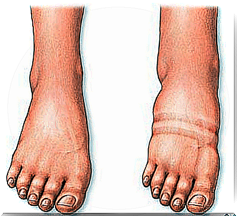 fluid retention