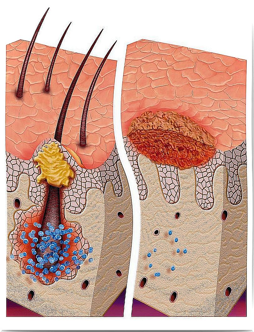 hair follicle inflammation