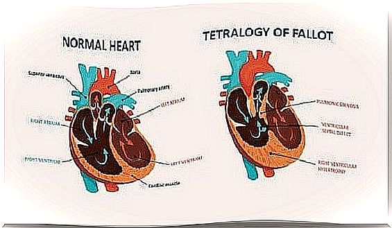 Congenital heart disease