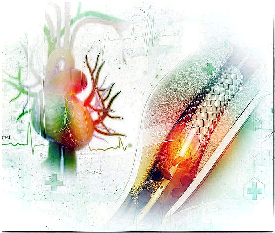 Coronary angioplasty