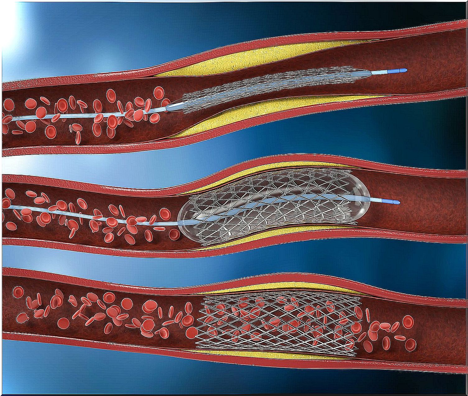 Coronary angioplasty is a procedure performed under local anesthesia in a hemodynamic room.