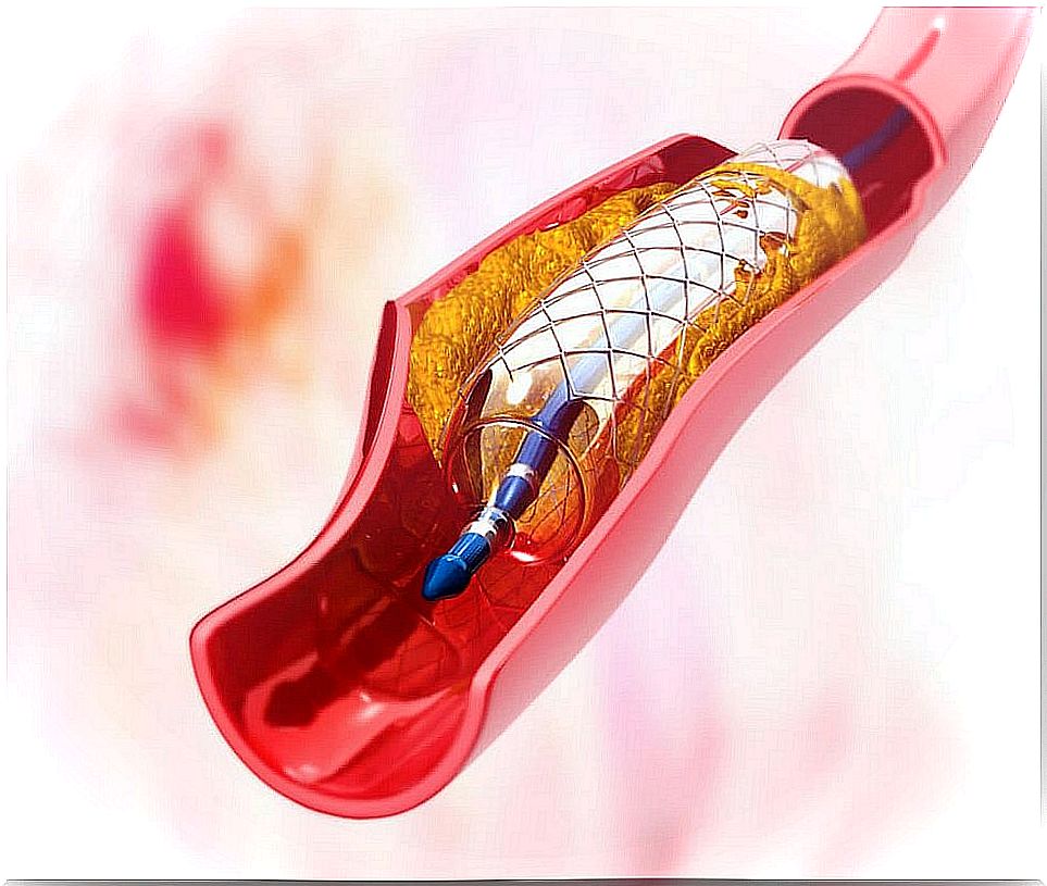 Previous recommendations-coronary angioplasty