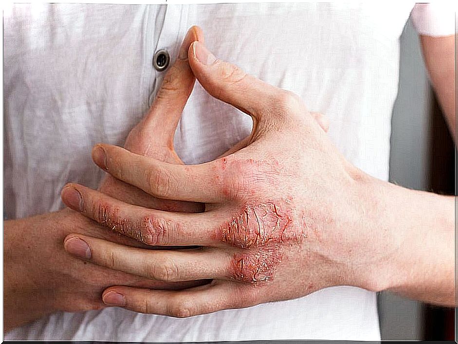 Man-affected-by-eczema-on-hands