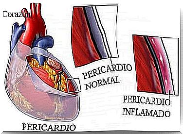 Pericarditis: symptoms, causes and treatment