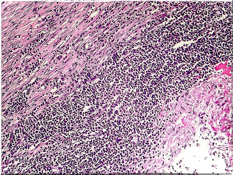 pericarditis