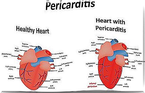 Heart with pericarditis