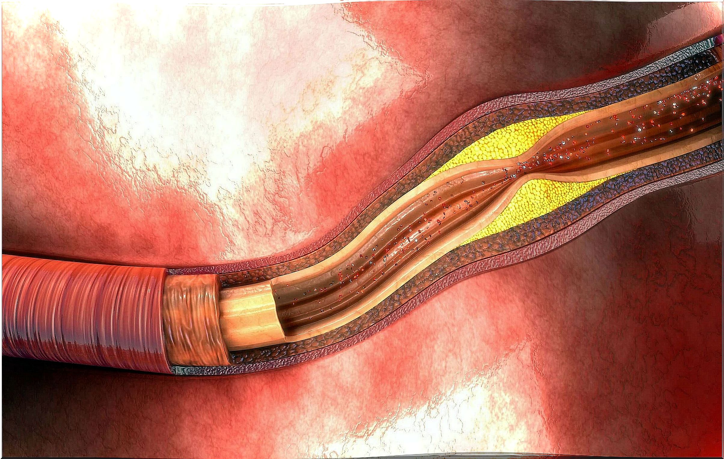 Peripheral arterial disease can be caused by atherosclerosis.