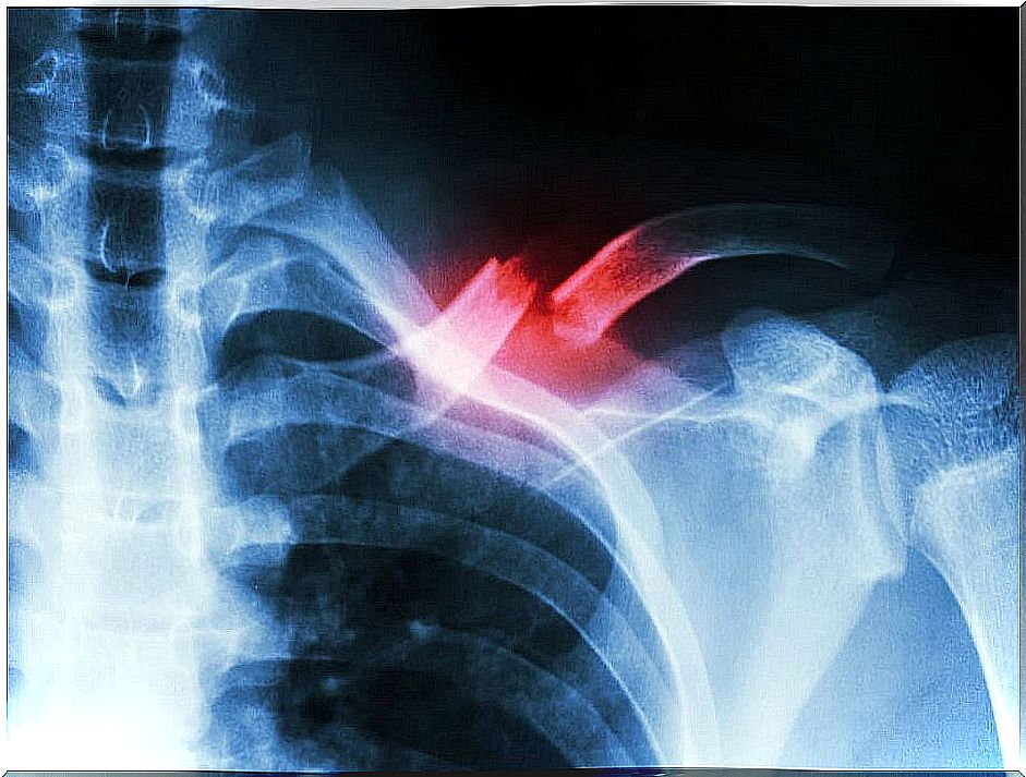 X-ray of a clavicle fracture