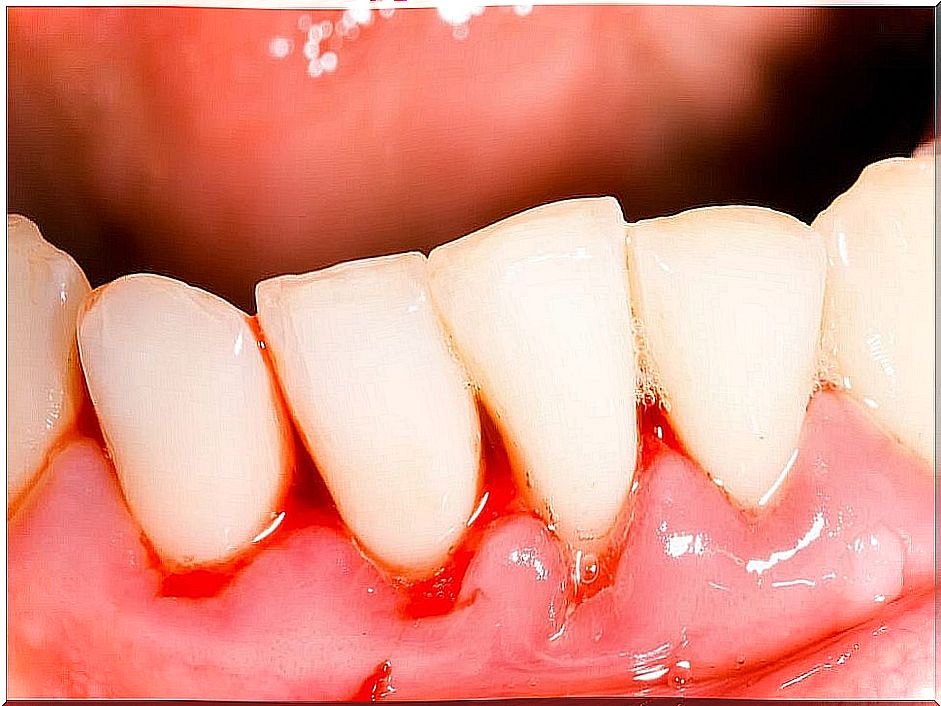 Severe gingivitis called "trench mouth".