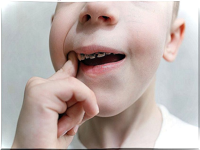 boy with tooth decay and a finger in his mouth